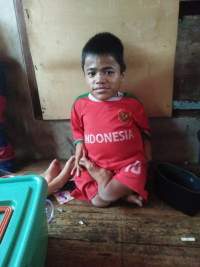 Alami Kelumpuhan Sejak Bayi, Malawi Butuh Uluran Tangan