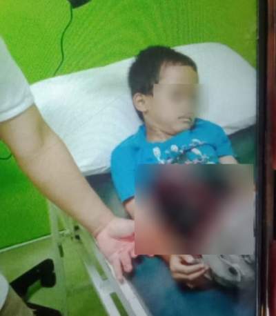 Dua Tangan Bocah Luka Parah, Digigit Monyet Liar di Kawasan Perumahan Puspitek